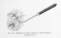 view M0007798: Method of tying vessels in dense tissues, from Cheyne: <i>Antiseptic Surgery</i> (1882)