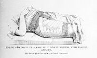 view M0007816: Hip joint abscess dressing, from Cheyne: <i>Antiseptic Surgery</i> (1882)