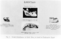 view M0007604: 'Dental Disturbances in Early Man, Predynastic Egypt'