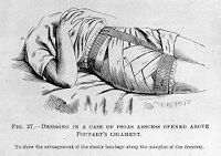 view M0007805: Surgical dressing, from Cheyne: <i>Antiseptic Surgery</i> (1882)