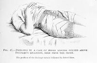 view M0007813: Dressing for abscess with drainage tube, from Cheyne: <i>Antiseptic Surgery</i> (1882)