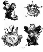 view M0008868: History of Spondylitis deformans