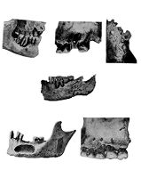 view M0009070: Abnormalities of Ancient Egyptian teeth