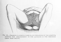 view M0007820: Hernia and scrotal dressing, from Cheyne: <i>Antiseptic Surgery</i> (1882)
