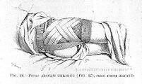 view M0007814: Abscess dressing from behind, from Cheyne: <i>Antiseptic Surgery</i> (1882) / M0007815: Lumbar abscess dressing from behind, from Cheyne: <i>Antiseptic Surgery</i> (1882)