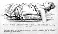 view M0007803: Wound after removal of mamma and axillary glands, from Cheyne: <i>Antiseptic Surgery</i> (1882)
