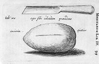 view M0010897: Knife used in an autolithotomy and the extracted stone