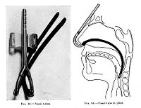 view M0009670: Nasal tubes in intrapharyngeal anaesthesia.