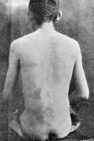 view M0009983EA: Youth with syphilitic sores on his back: after treatment / M0009983EB Youth with syphilitic sores on his back: before treatment