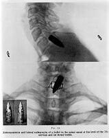 view M0010713: Radiographs of a bullet in the spinal canal