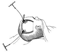 view M0010592: 20th century brain surgery: first stage in osteoplastic flap