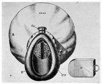 view M0009973: Ormsby' s inhaler (Woodhouse Branne's pattern) with Hewitt's modification