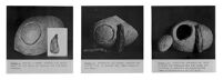 view M0011772: Reproduction of a series of three photographs showing the three stages of trephination technique from the Neolithic era