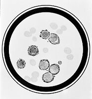 view M0013296: Specimen of chronic lymphatic leukaemia
