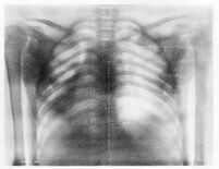 view M0013198: Radiograph of the thorax.