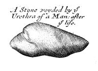 view M0013884: Illustration of a kidney stone, 1681