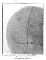 view M0013196: Radiograph showing a bullet in the brain of a living subject