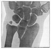 view M0013197: Radiograph showing a double colles' fracture.