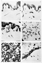 view M0013307: Magnification of erysipelas in the skin
