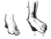 view M0014487: Clubfoot in a boy aged eleven