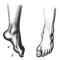view M0014488: Clubfoot, due to muscle atrophy
