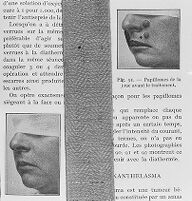 view M0015389: Treatment of papillomas of the skin by diathermic coagulation: before and after