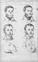 view M0015269: Illustrations of Carpue's operation for restoring the nose and Cline's operation for restoring the lip, 1825