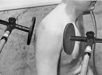 view M0015440: Application of short-wave diathermy employing rigid plates and adjustable arms