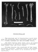 view M0015762: Bones of Neanderthal Man, with descriptive text relating to supposed signs of disease