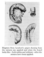 view M0016172: Diagrams from Lemberts paper showing how the sutures are applied and what the bowel looks like