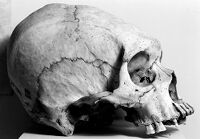 view M0016054: Skull showing cranial elongation produced by circular constriction, Vanuatu