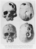 view M0016565: Human skeletal remains showing trephining