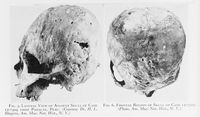 view M0016558: Two views of an ancient syphilitic skull from Paracas, Peru