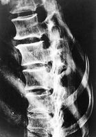 view M0016990: X-ray of a spine showing lesions from a woman from a pre-dynastic burial, Egypt