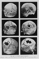 view M0016569: Six skulls showing trephination , Peru