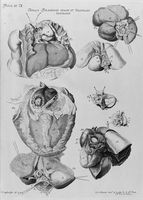 view M0017122: Set of diagrams of the foramen ovale and eustacian valve in the heart, 1743