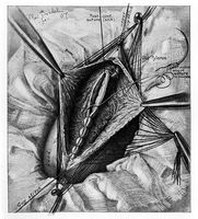 view M0017093: Illustration of a pyloroplastic operation, 1907