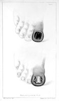 view M0017270: Illustration of toenails growing into flesh, 1845