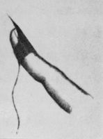 view M0017273: Instrument for excision of cervical and fundal polyps used in 1857