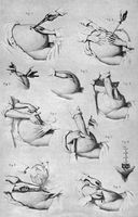 view M0017875: Diagram of the steps involved in the removal of an ovarian cyst, 1888