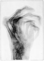 view M0019124: X-ray of a hand deformed by osteo-arthritis, c.1897