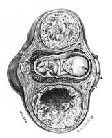 view M0019652: Illustration of a gravid uterus with twin fibroids, 1917