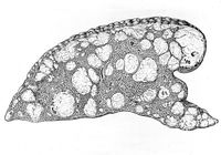view M0019637: Illustration of a section of lung with nodules of sarcoma, 1917