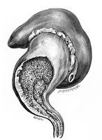 view M0019685: Illustration of the kidney showing papillomas invading and blocking ureter, 1922