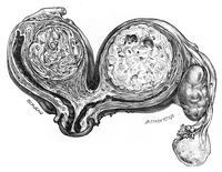view M0019649: Illustration of a bi-cornate uterus of which each cornu contains an interstitial fibroid, 1917