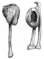 view M0019641: Illustration of changes produced in the ulna, radius and fibula by a myeloma, 1917