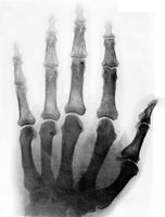 view M0019472: X-ray photograph of the left hand of  Lord Joseph Lister
