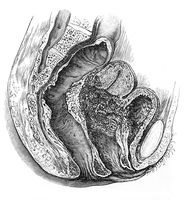 view M0019689: Illustration of the pelvis viscera in section showing cancer of the cervix, 1922