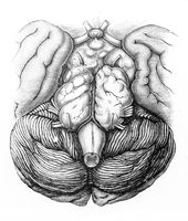 view M0019647: Illustration of a bilateral gliomatous enlargement of the pons and crura cerebri, 1917
