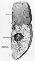 view M0019681: Illustration of squamous-celled cancer of the gall-bladder, 1922